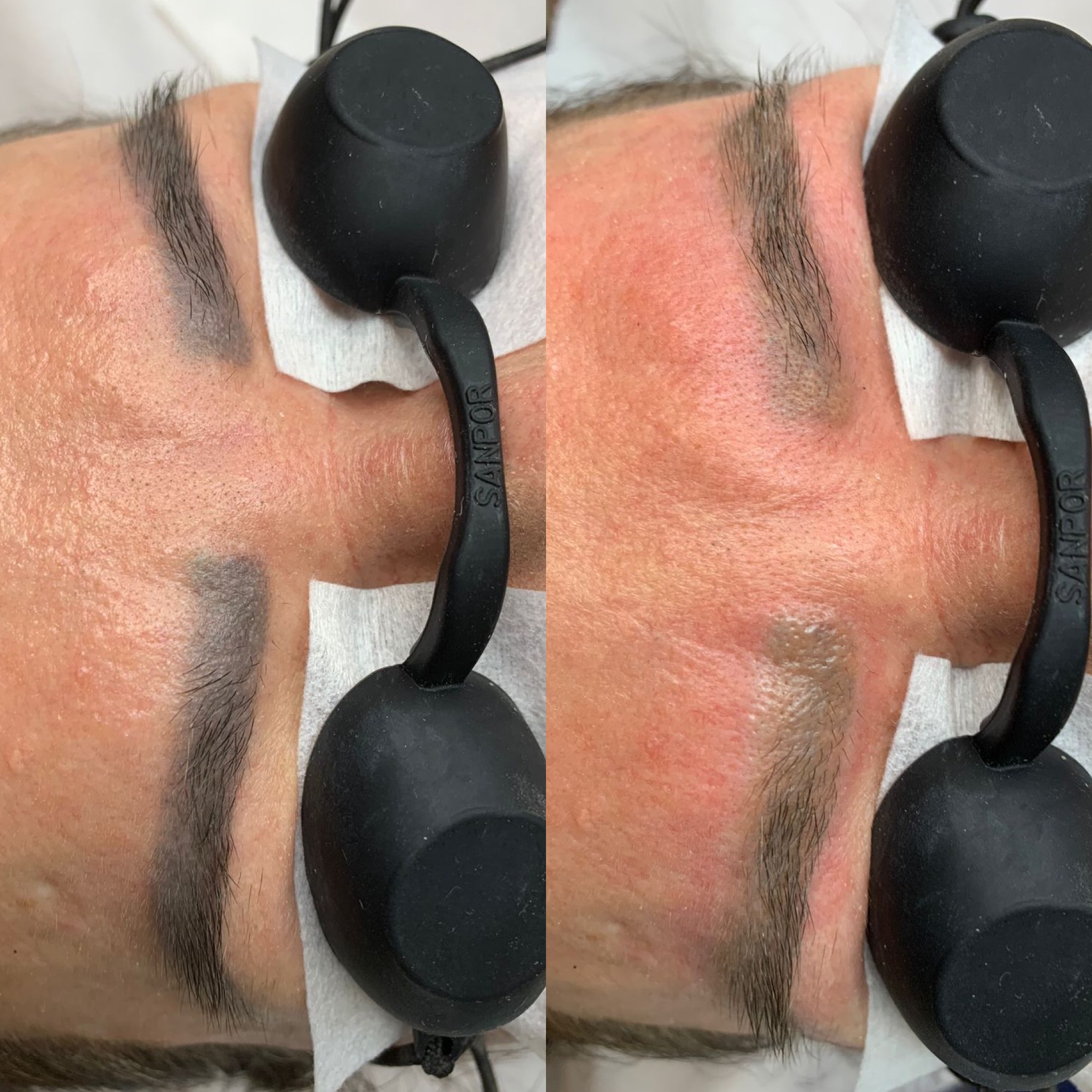 Resultado de remoção a laser